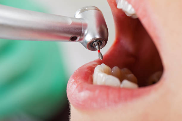 Best Emergency Dental Care for Broken or Chipped Teeth in Pompano Beach, FL